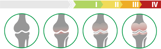 Клінічныя стадыі артрозу каленнага сустава (ступень артрозу каленнага сустава)