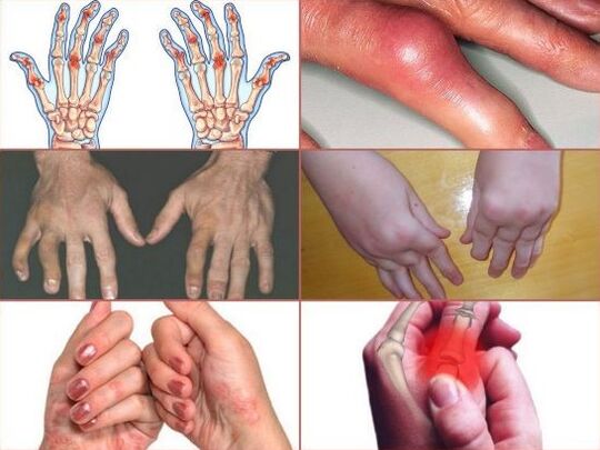 болевыя адчуванні ў суставах пальцаў рук